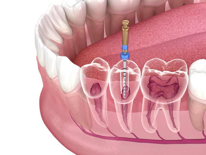 Laser-Assisted Root Canal Treatment