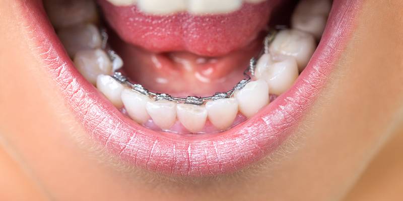 Lingual Braces: The Invisible Solution for Orthodontic Treatment