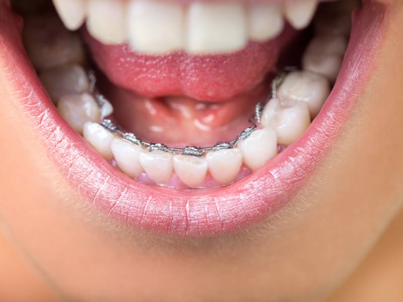 Lingual Braces: The Invisible Solution for Orthodontic Treatment