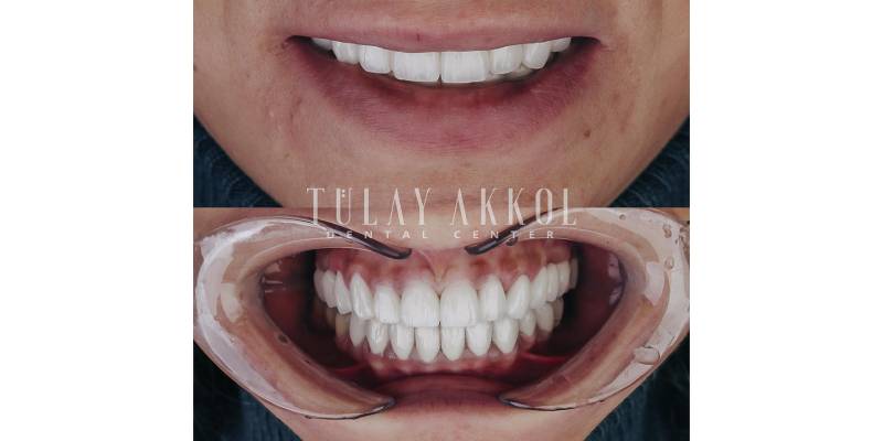 Navigating the Costs of a Full Set of Veneers in Turkey