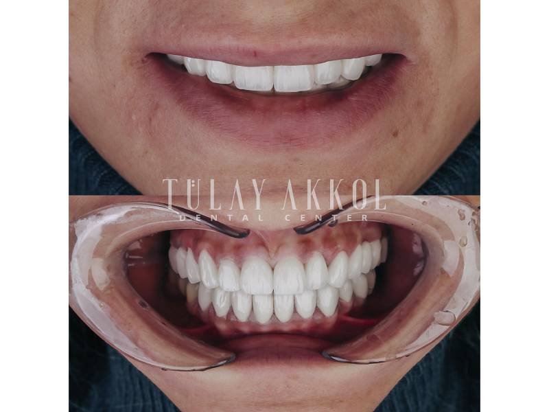 Navigating the Costs of a Full Set of Veneers in Turkey