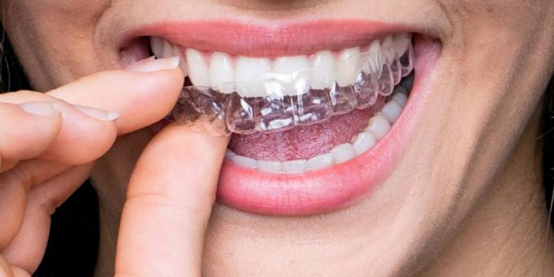 Porcelain Dental Braces (Transparent Dental Braces)