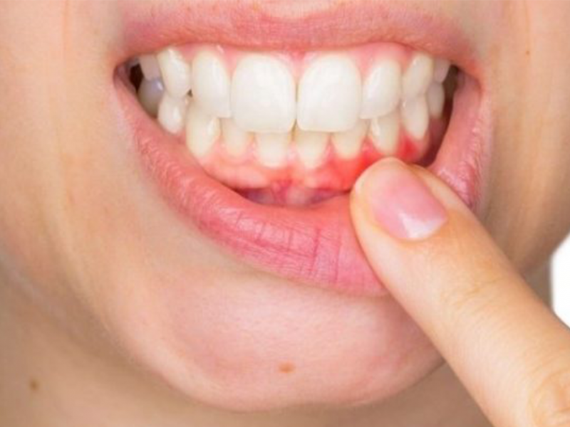 Swollen Gum Behind Back Tooth: Causes and Treatment Options