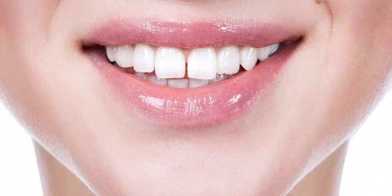 Teeth Gap Filling Cost: Factors to Consider for a Beautiful Smile