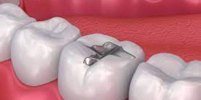 Which Type Of Dental Filling To Use Longer?