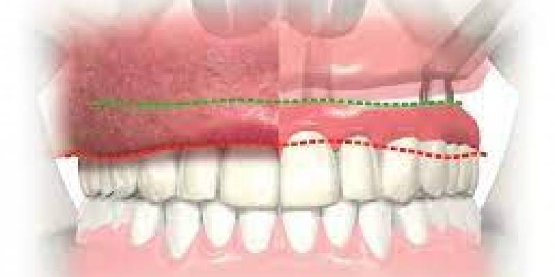 Zygoma Method