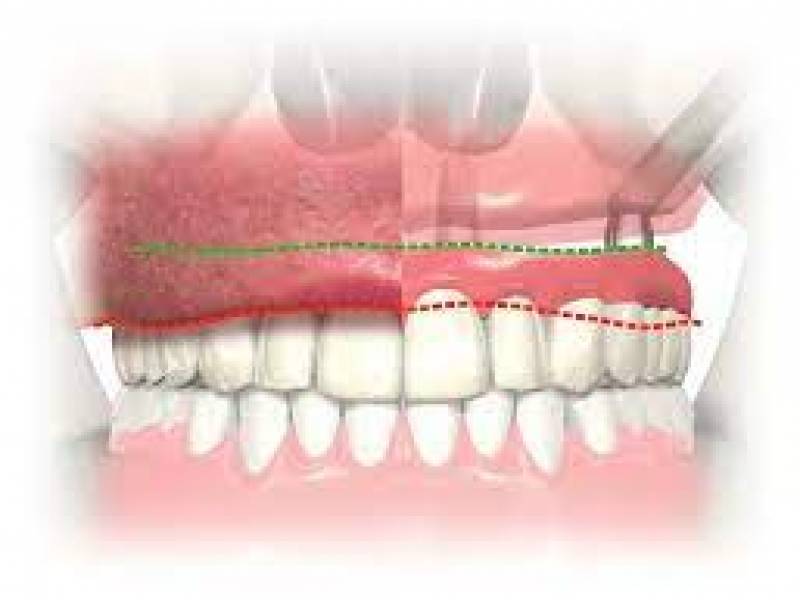 Zygoma Method